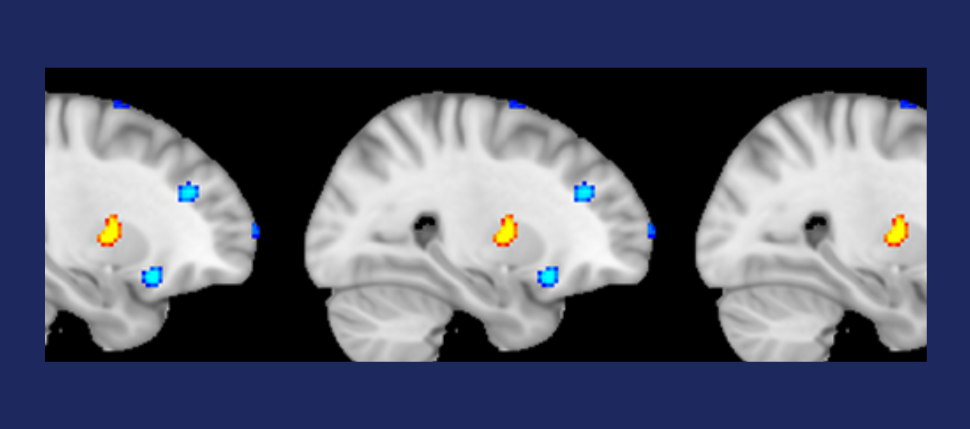 Computers can ‘spot the difference’ between healthy brains and the brains of people with Dissociative Identity Disorder
