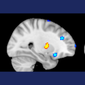 Computers can ‘spot the difference’ between healthy brains and the brains of people with Dissociative Identity Disorder