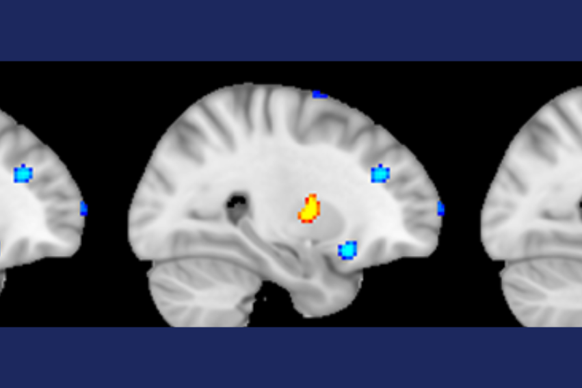 Computers can ‘spot the difference’ between healthy brains and the brains of people with Dissociative Identity Disorder