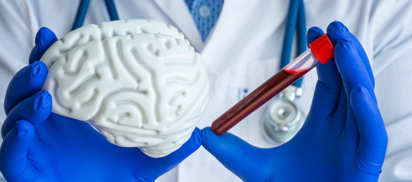 Simple blood test can accurately reveal underlying neurodegeneration, according to new research