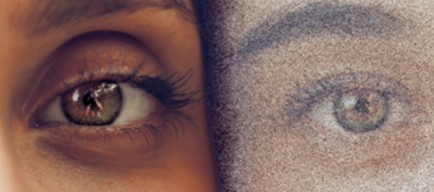 New brain scan study discovers possible biological basis of visual snow syndrome