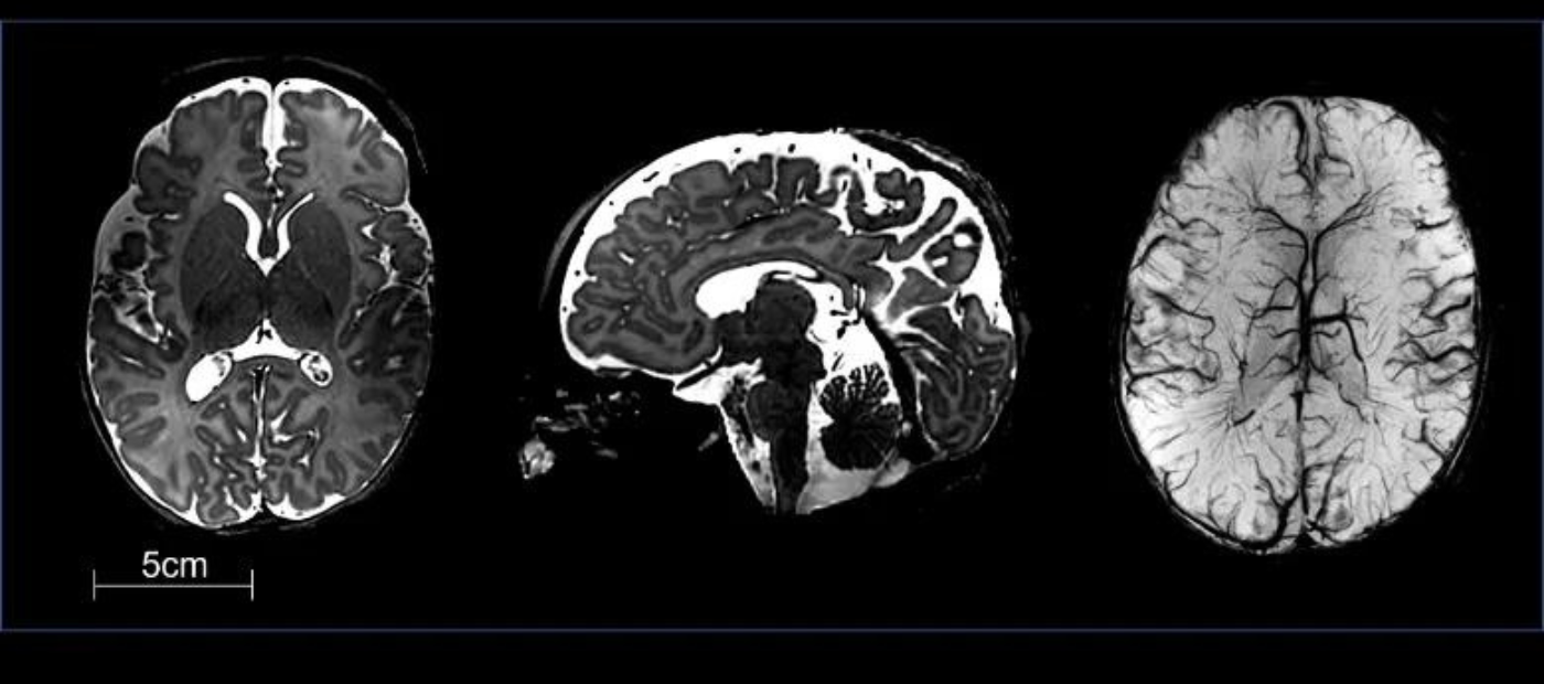 Major advance for detecting brain conditions in babies