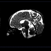 Three black and white MRI brain scans showing axial, sagittal, and coronal views, revealing intricate details of the brain's structure
