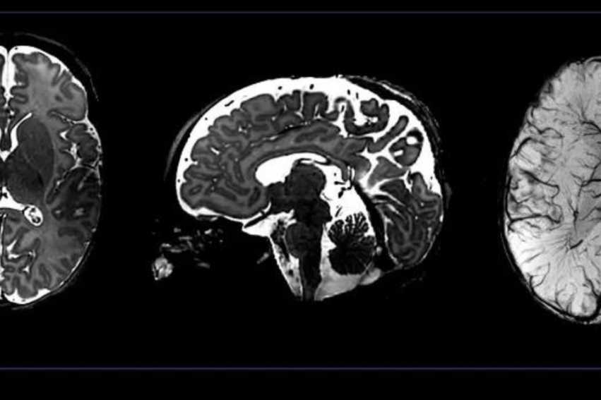 Three black and white MRI brain scans showing axial, sagittal, and coronal views, revealing intricate details of the brain's structure