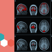 Brain scan images showing different sections with highlighted red areas on the right, with a blue plus and hexagons on a coral background on the left.