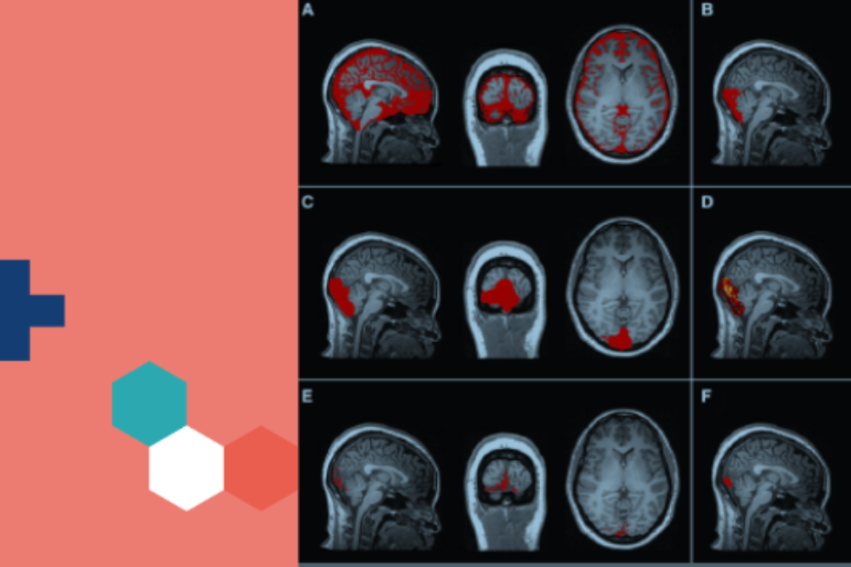 Brain scan images showing different sections with highlighted red areas on the right, with a blue plus and hexagons on a coral background on the left.