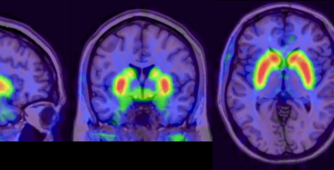 Using neuroimaging to target treatment in psychosis